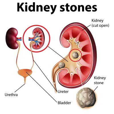 Percutaneous Nephrolithotomy